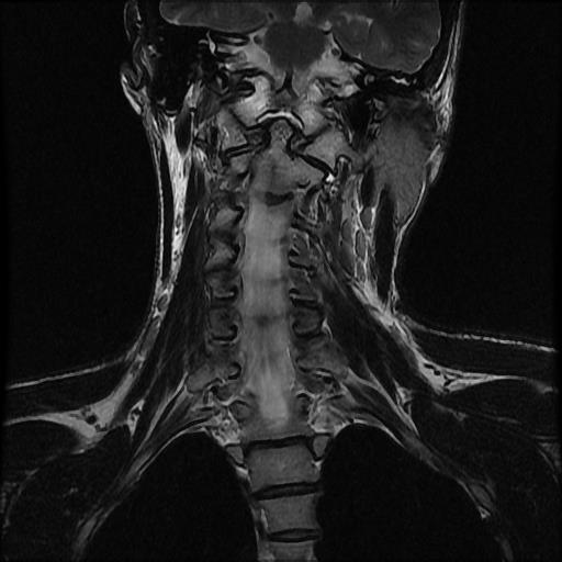 File:Atlas fracture (Radiopaedia 64277-73052 Coronal T2 6).jpg