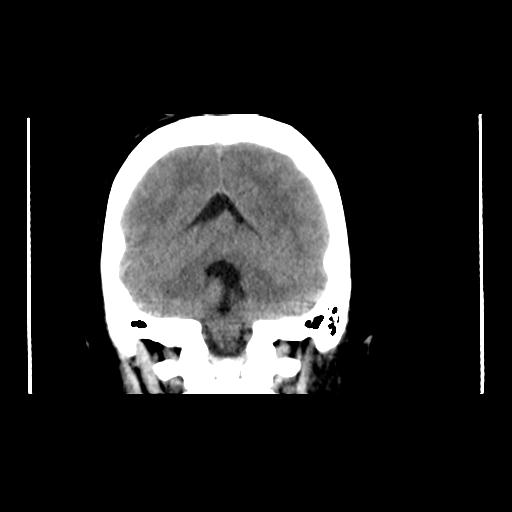 File:Atretic encephalocoele with inferior vermis hypoplasia (Radiopaedia 30443-31107 A 1).jpg