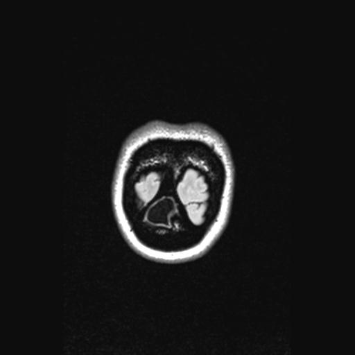 Atretic encephalocoele with inferior vermis hypoplasia (Radiopaedia 30443-31108 Coronal FLAIR 15).jpg