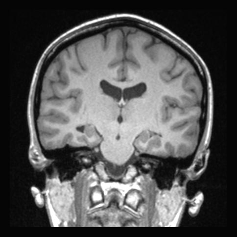 Atretic encephalocoele with inferior vermis hypoplasia (Radiopaedia 30443-31108 Sagittal T1 126).jpg