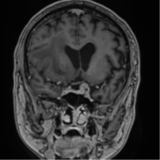 Atypical meningioma (WHO grade II) with brain invasion (Radiopaedia 57767-64729 Coronal T1 C+ 33).png