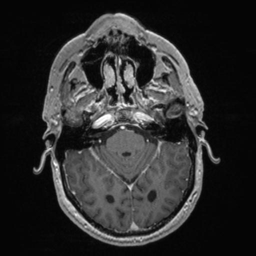 Atypical meningioma (grade II) - en plaque (Radiopaedia 29633-30147 Axial T1 C+ 61).jpg