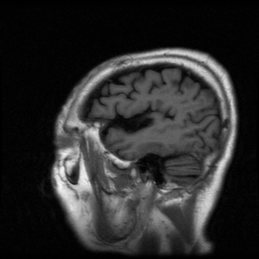 File:Atypical meningioma with skull invasion (Radiopaedia 34357-35648 Sagittal T1 5).png