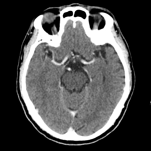 Atypical meningioma with skull invasion (Radiopaedia 34357-35649 Axial C+ delayed 22).png