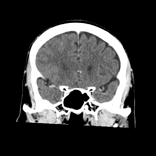 Atypical meningioma with skull invasion (Radiopaedia 34357-35649 Coronal C+ delayed 22).png