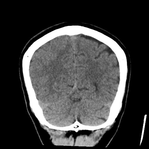 Atypical meningioma with skull invasion (Radiopaedia 34357-35649 Coronal non-contrast 49).png