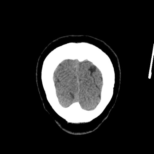 Atypical meningioma with skull invasion (Radiopaedia 34357-35649 Coronal non-contrast 60).png