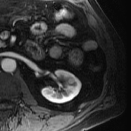 File:Atypical renal cyst on MRI (Radiopaedia 17349-17046 C 16).jpg