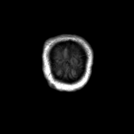 Autoimmune limbic encephalitis (Radiopaedia 30363-31005 Coronal T1 4).jpg