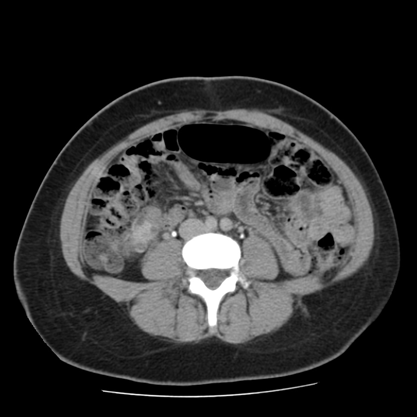 Autosomal dominant polycystic kidney disease (Radiopaedia 23061-23093 C+ delayed 43).jpg