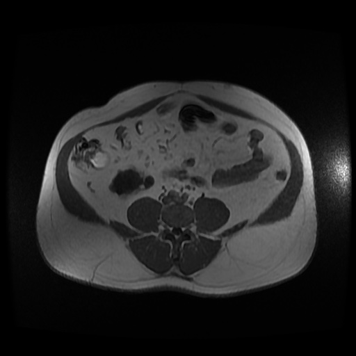 Autosomal dominant polycystic kidney disease (Radiopaedia 50259-55611 Axial 2D Dual Echo 70).jpg