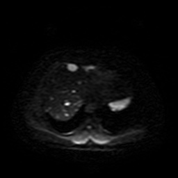 Autosomal dominant polycystic kidney disease (Radiopaedia 50259-55611 Axial DWI 5).jpg