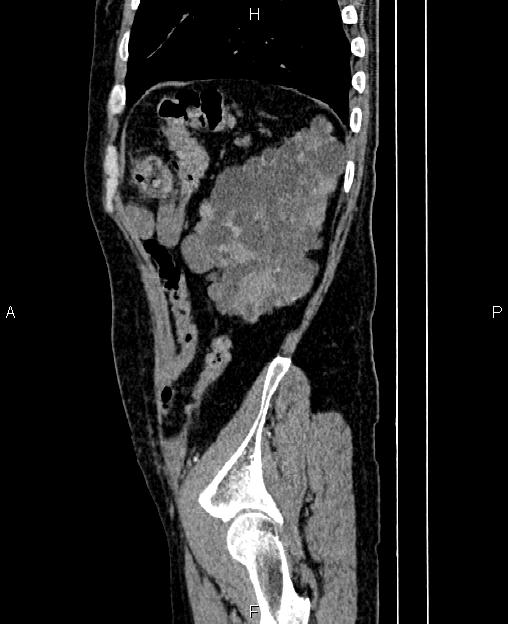 Autosomal dominant polycystic kidney disease (Radiopaedia 87830-104287 C 77).jpg