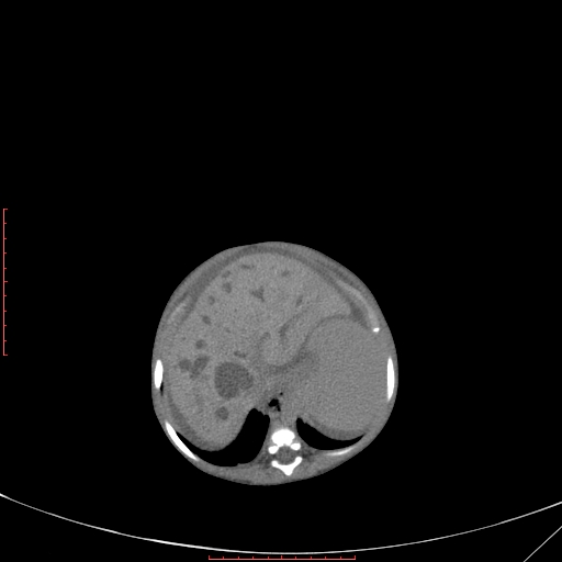 Autosomal recessive polycystic kidney disease associated with Caroli disease (Radiopaedia 61932-69984 B 114).jpg