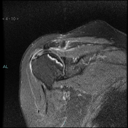File:Avascular necrosis of the shoulder - Cruess stage I (Radiopaedia 77674-89886 Coronal PD fat sat 10).jpg