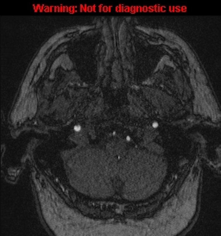 Azygos anterior cerebral artery (Radiopaedia 59325-66677 Axial MRA 14).jpg