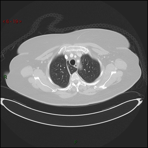 File:Azygos fissure and lobe (Radiopaedia 47620-52278 Axial lung window 19).jpg