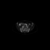 B-cell lymphoma of the mesentery (Radiopaedia 65743-74868 18F-FDG PET-CT 98).jpg