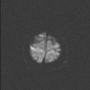 Balo concentric sclerosis (Radiopaedia 50458-55940 Axial DWI 48).jpg