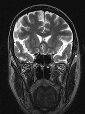 File:Balo concentric sclerosis (Radiopaedia 50458-55940 Coronal T2 19).jpg