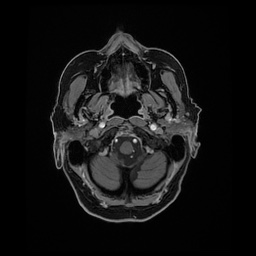 Balo concentric sclerosis (Radiopaedia 53875-59982 Axial LAVA C+ 30).jpg