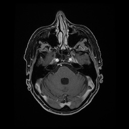 Balo concentric sclerosis (Radiopaedia 53875-59982 Axial LAVA C+ 74).jpg