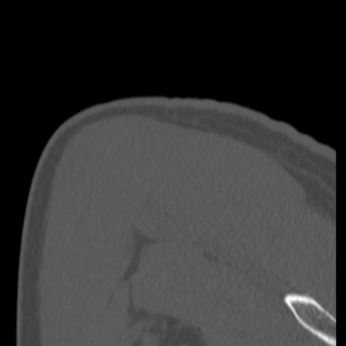 Bankart lesion (Radiopaedia 57256-64185 Coronal bone window 43).jpg