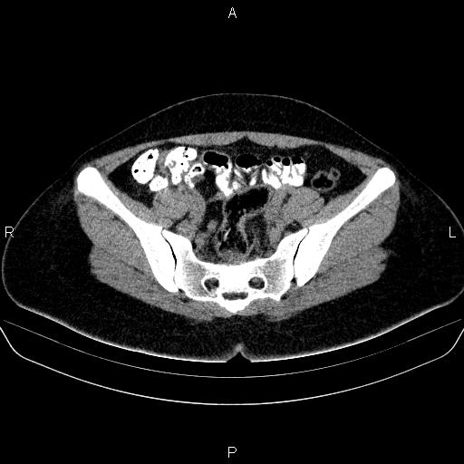 Bartholin gland cyst (Radiopaedia 62635-70930 Axial non-contrast 30).jpg