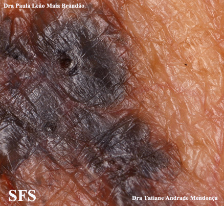 Basal Cell Carcinoma (Dermatology Atlas 236).jpg