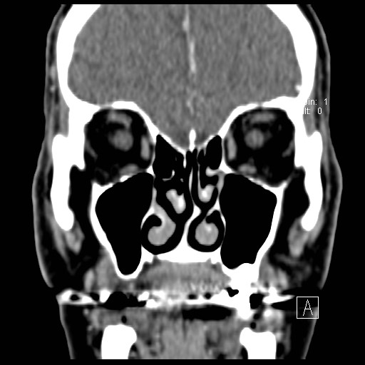 File:Basal cell carcinoma (periocular with orbital invasion) (Radiopaedia 30974-31672 Coronal Postcontrast 17).jpg