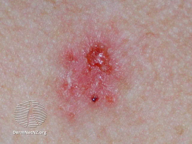 File:Basal cell carcinoma affecting the trunk (DermNet NZ lesions-bcc-trunk-0740).jpg