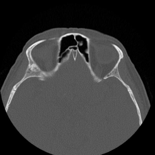 File:Base of skull chondrosarcoma (Radiopaedia 30410-31071 Axial bone window 32).jpg