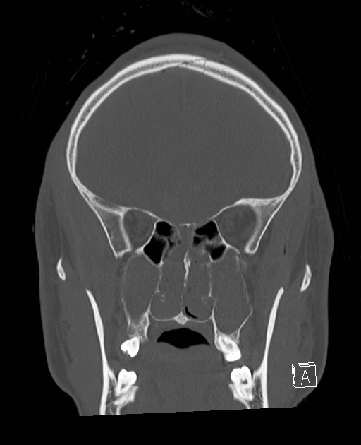 Base of skull fracture with bilateral Le Fort fractures (Radiopaedia 47094-51638 Coronal bone window 68).jpg