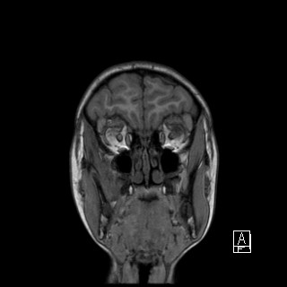 Base of skull rhabdomyosarcoma (Radiopaedia 32196-33142 Coronal T1 5).jpg