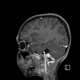 Base of skull rhabdomyosarcoma (Radiopaedia 32196-33142 J 44).jpg