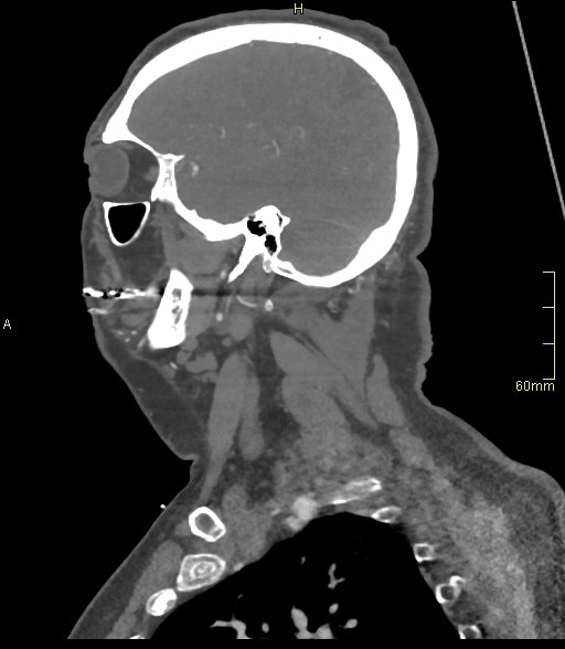 File:Basilar artery aneurysm (Radiopaedia 56261-62932 C 2).jpg