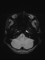 File:Basilar artery perforator aneurysm (Radiopaedia 82455-97733 Axial SWI 7).jpg
