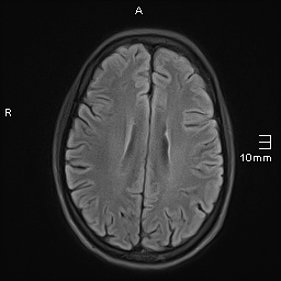 File:Basilar artery perforator aneurysm (Radiopaedia 82455-99523 Axial FLAIR 15).jpg
