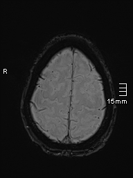 Basilar artery perforator aneurysm (Radiopaedia 82455-99523 Axial SWI 57).jpg