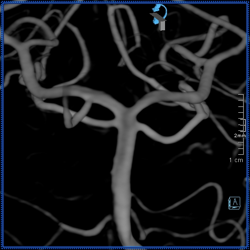 File:Basilar artery perforator aneurysm (Radiopaedia 82455-99524 3D Left VA 45).jpg