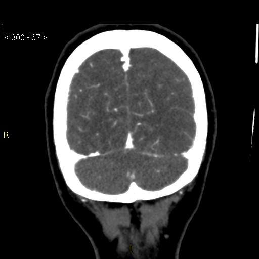File:Basilar artery thrombosis (Radiopaedia 16260-15944 B 58).jpg
