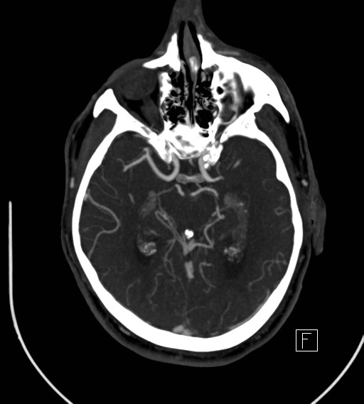 Basilar artery thrombosis (Radiopaedia 26986-27163 A 40).jpg