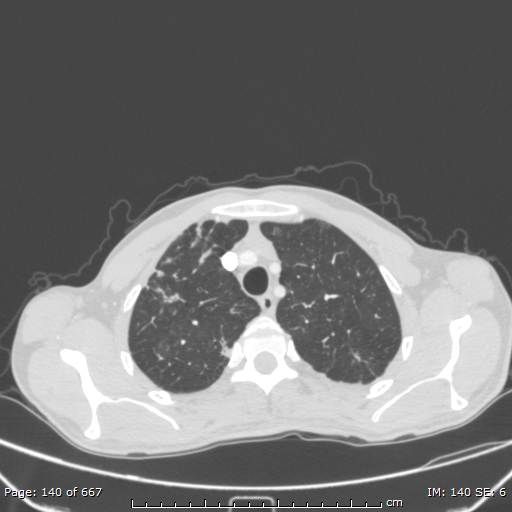 File:Behçet disease (Radiopaedia 44247-47889 Axial lung window 14).jpg