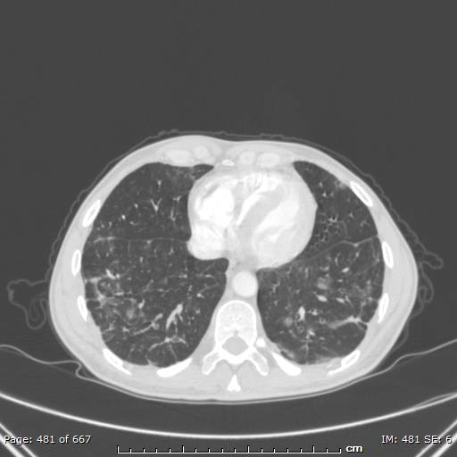File:Behçet disease (Radiopaedia 44247-47889 Axial lung window 66).jpg