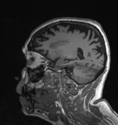 Behavioral variant frontotemporal dementia and late onset schizophrenia (Radiopaedia 52197-58083 Sagittal T1 27).png
