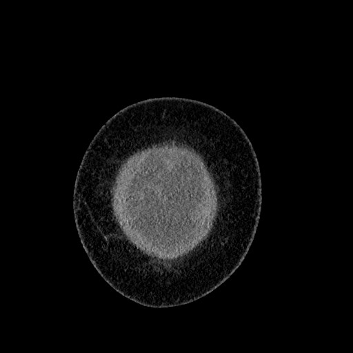 File:Benign leiomyoma with hydropic features (Radiopaedia 89250-106130 B 7).jpg