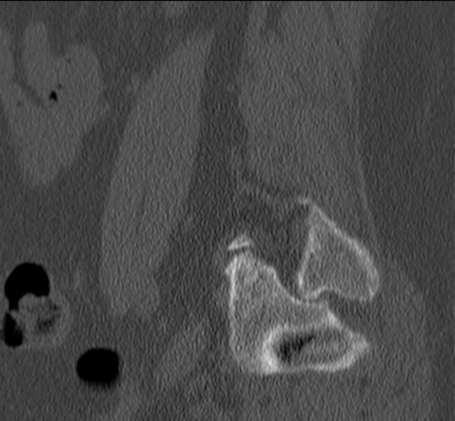 Bertolotti syndrome (Radiopaedia 24864-25128 Sagittal bone window 50).jpg
