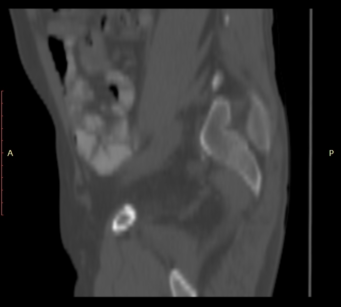 Bertolotti syndrome (Radiopaedia 58974-66235 Sagittal bone window 2).jpg