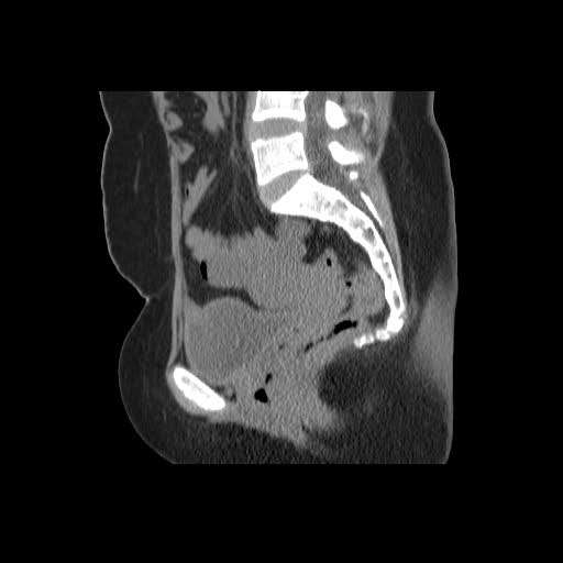 File:Bicornuate uterus- on MRI (Radiopaedia 49206-54296 A 10).jpg