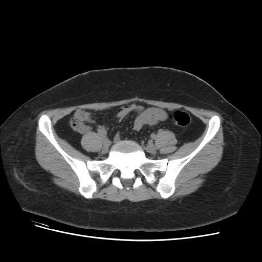 File:Bicornuate uterus- on MRI (Radiopaedia 49206-54296 Axial non-contrast 2).jpg